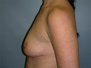 Breast Augmentation Before and After Pictures Miami, FL