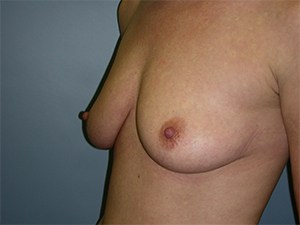 Breast Augmentation Before and After Pictures Miami, FL