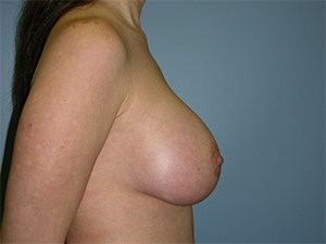 Breast Augmentation Before and After Pictures Miami, FL