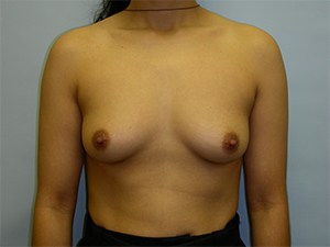 Breast Augmentation Before and After Pictures Miami, FL