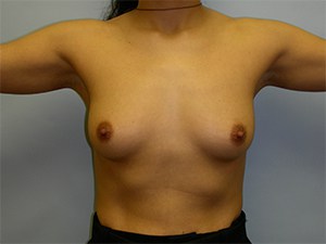 Breast Augmentation Before and After Pictures Miami, FL