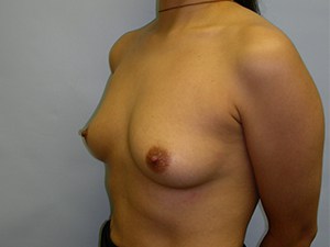 Breast Augmentation Before and After Pictures Miami, FL