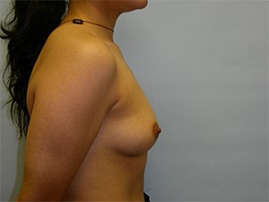 Breast Augmentation Before and After Pictures Miami, FL