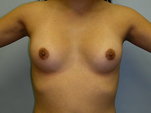 Breast Augmentation Before and After Pictures Miami, FL