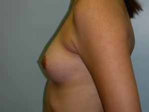 Breast Augmentation Before and After Pictures Miami, FL