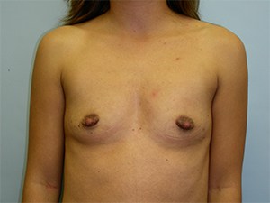 Breast Augmentation Before and After Pictures Miami, FL