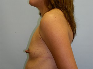 Breast Augmentation Before and After Pictures Miami, FL