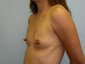 Breast Augmentation Before and After Pictures Miami, FL