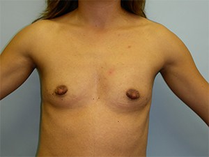 Breast Augmentation Before and After Pictures Miami, FL