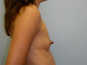 Breast Augmentation Before and After Pictures Miami, FL