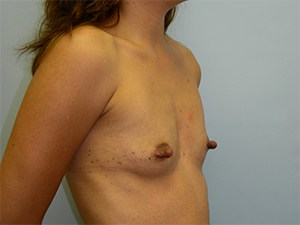 Breast Augmentation Before and After Pictures Miami, FL