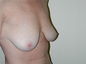 Breast Lift and Augmentation Before and After Pictures Miami, FL