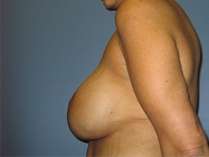 Breast Lift and Augmentation Before and After Pictures Miami, FL