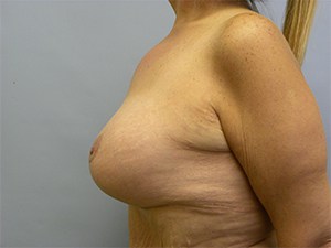 Breast Lift and Augmentation Before and After Pictures Miami, FL