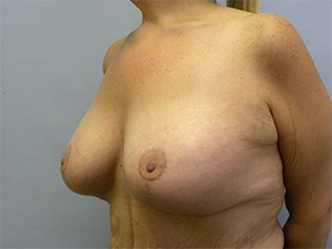 Breast Lift and Augmentation Before and After Pictures Miami, FL