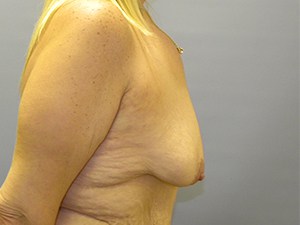 Breast Lift and Augmentation Before and After Pictures Miami, FL