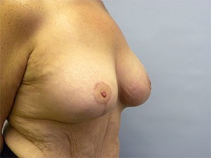 Breast Lift and Augmentation Before and After Pictures Miami, FL