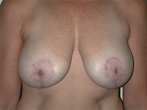 Breast Lift and Augmentation Before and After Pictures Miami, FL