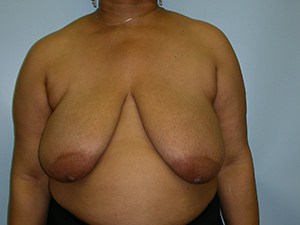 Breast Reduction Before and After Pictures Miami, FL