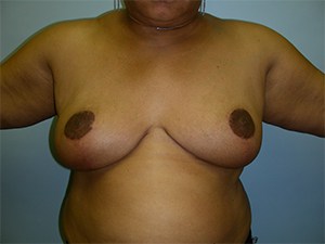 Breast Reduction Before and After Pictures Miami, FL