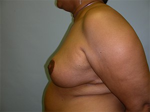 Breast Reduction Before and After Pictures Miami, FL