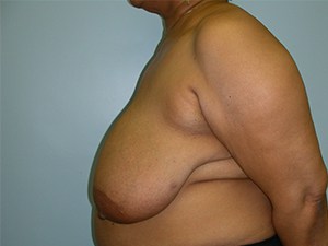 Breast Reduction Before and After Pictures Miami, FL