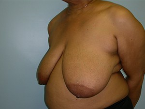 Breast Reduction Before and After Pictures Miami, FL