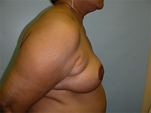 Breast Reduction Before and After Pictures Miami, FL