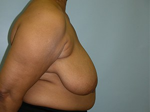 Breast Reduction Before and After Pictures Miami, FL