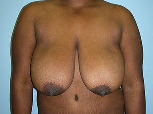 Breast Reduction Before and After Pictures Miami, FL