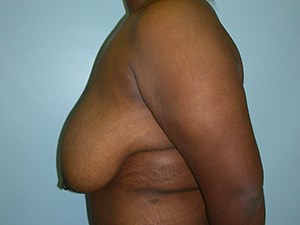 Breast Reduction Before and After Pictures Miami, FL