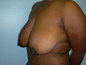 Breast Reduction Before and After Pictures Miami, FL