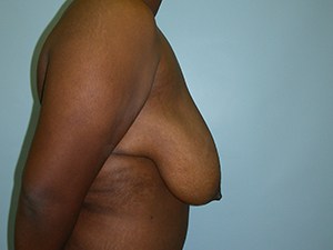 Breast Reduction Before and After Pictures Miami, FL