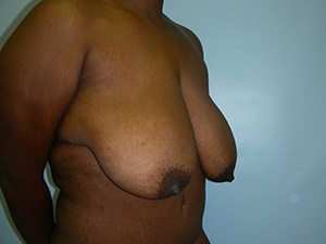 Breast Reduction Before and After Pictures Miami, FL