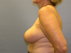 Breast Reduction Before and After Pictures Miami, FL