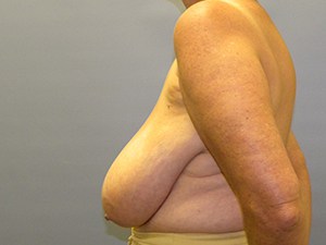 Breast Reduction Before and After Pictures Miami, FL