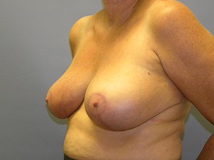 Breast Reduction Before and After Pictures Miami, FL