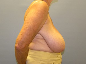 Breast Reduction Before and After Pictures Miami, FL