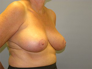 Breast Reduction Before and After Pictures Miami, FL