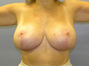 Breast Reduction Before and After Pictures Miami, FL