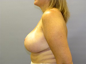 Breast Reduction Before and After Pictures Miami, FL