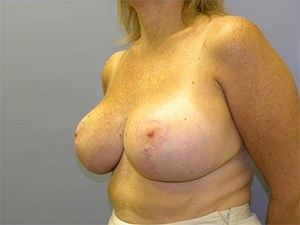 Breast Reduction Before and After Pictures Miami, FL