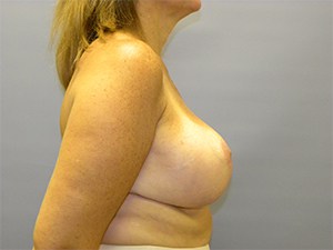 Breast Reduction Before and After Pictures Miami, FL