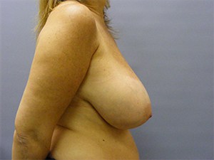 Breast Reduction Before and After Pictures Miami, FL