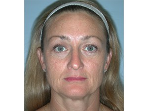 Brow Lift Before and After Pictures Miami, FL