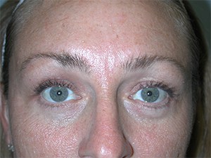 Brow Lift Before and After Pictures Miami, FL