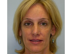 Brow Lift Before and After Pictures Miami, FL