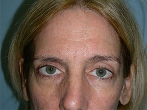 Brow Lift Before and After Pictures Miami, FL