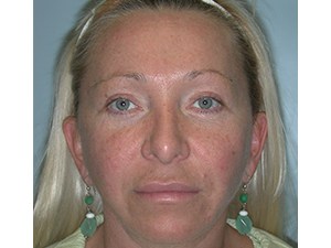 Mini Facelift Before and After Pictures Miami, FL