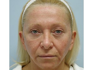 Mini Facelift Before and After Pictures Miami, FL